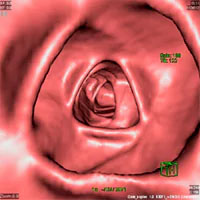 Colonoscopia virtual