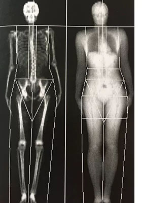 Grup Manchón densitometria dexa composición corporal