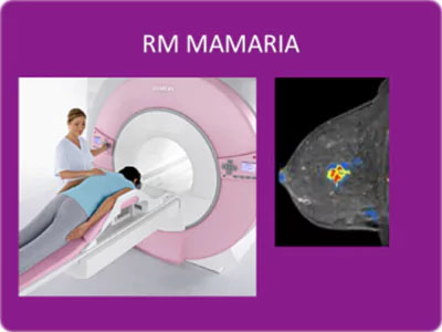 Resonancia Magnética de mama