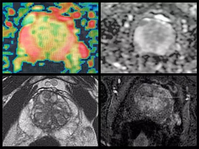 cancer la prostata forum autoanalisis próstata